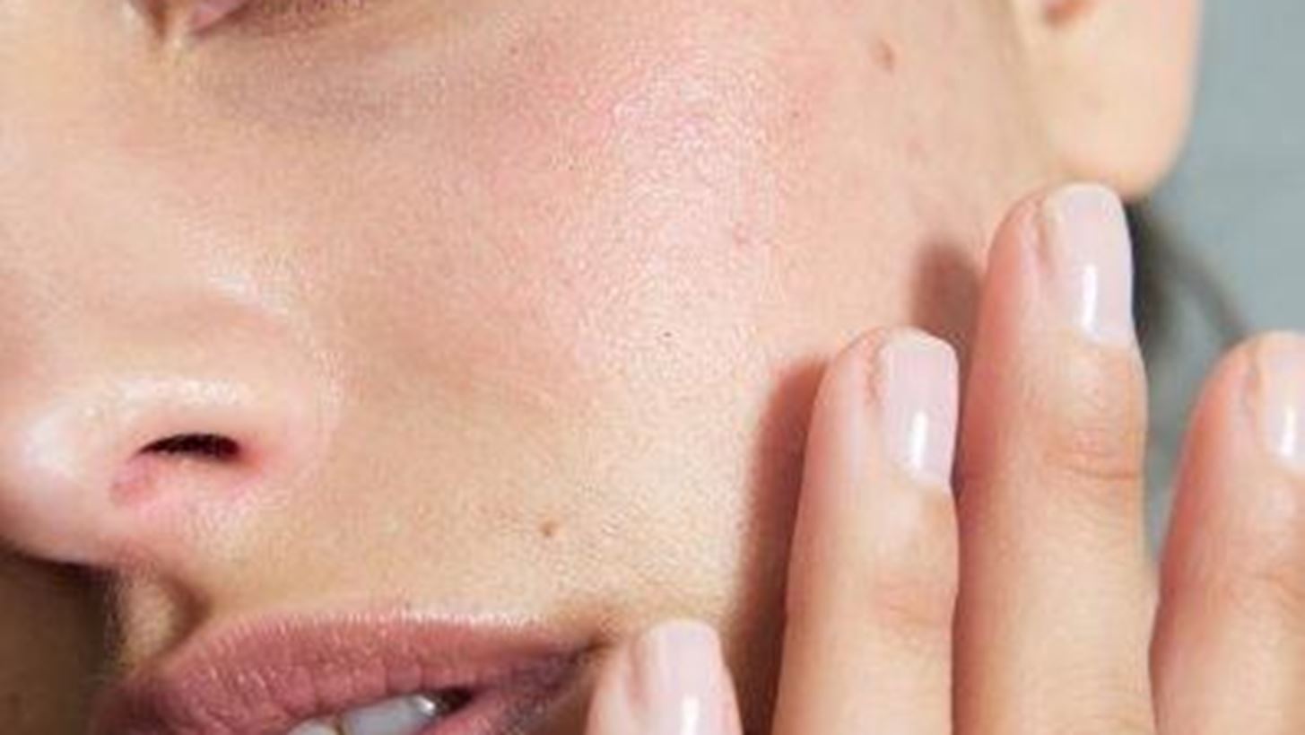 Post Summer Acne | &#x3A0;&#x3CE;&#x3C2; &#x3BD;&#x3B1; &#x3B1;&#x3C0;&#x3B1;&#x3BB;&#x3BB;&#x3B1;&#x3B3;&#x3B5;&#x3AF;&#x3C2; &#x3B1;&#x3C0;&#x3CC; &#x3C4;&#x3B7;&#x3BD; &#x3B1;&#x3BA;&#x3BC;&#x3AE; &#x3C0;&#x3BF;&#x3C5; &#x3B5;&#x3BC;&#x3C6;&#x3B1;&#x3BD;&#x3AF;&#x3B6;&#x3B5;&#x3C4;&#x3B1;&#x3B9; &#x3BC;&#x3B5;&#x3C4;&#x3AC; &#x3C4;&#x3B9;&#x3C2; &#x3B4;&#x3B9;&#x3B1;&#x3BA;&#x3BF;&#x3C0;&#x3AD;&#x3C2;