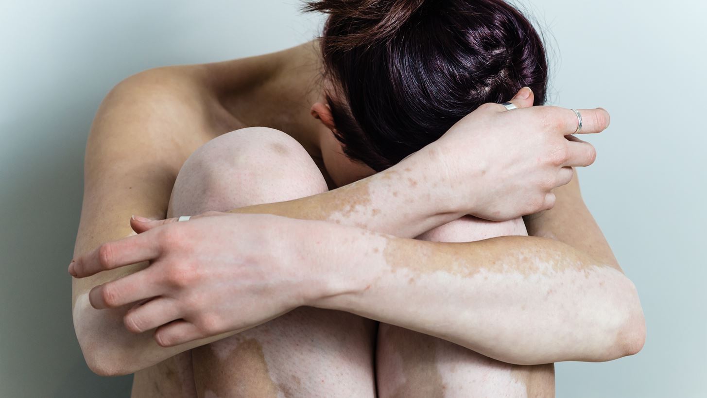 Έχεις λεύκη; Αυτές οι συμβουλές θα σού φανούν χρήσιμες