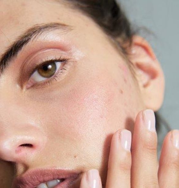 Post Summer Acne | &#x3A0;&#x3CE;&#x3C2; &#x3BD;&#x3B1; &#x3B1;&#x3C0;&#x3B1;&#x3BB;&#x3BB;&#x3B1;&#x3B3;&#x3B5;&#x3AF;&#x3C2; &#x3B1;&#x3C0;&#x3CC; &#x3C4;&#x3B7;&#x3BD; &#x3B1;&#x3BA;&#x3BC;&#x3AE; &#x3C0;&#x3BF;&#x3C5; &#x3B5;&#x3BC;&#x3C6;&#x3B1;&#x3BD;&#x3AF;&#x3B6;&#x3B5;&#x3C4;&#x3B1;&#x3B9; &#x3BC;&#x3B5;&#x3C4;&#x3AC; &#x3C4;&#x3B9;&#x3C2; &#x3B4;&#x3B9;&#x3B1;&#x3BA;&#x3BF;&#x3C0;&#x3AD;&#x3C2;