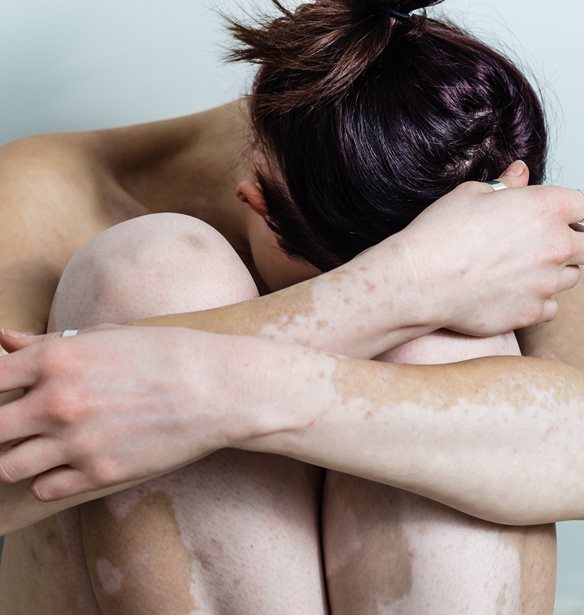 Έχεις λεύκη; Αυτές οι συμβουλές θα σού φανούν χρήσιμες